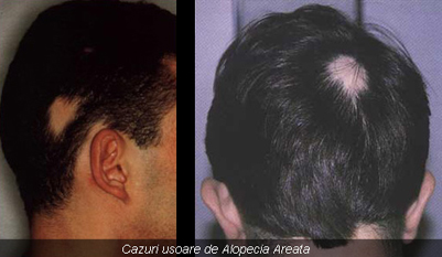Alopecia areata – pierderea localizată a părului, o afecțiune autoimună adesea asociată cu vitiligo.
