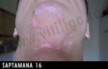 repigmentare vitiligo