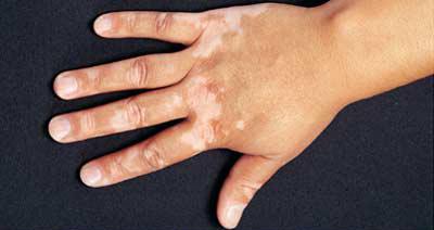 diagnosticul vitiligo