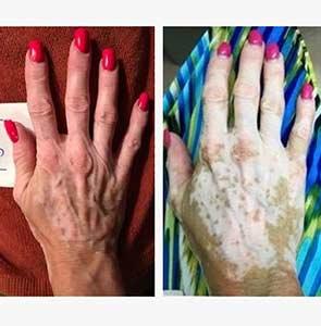 vitiligo apremilast otezla