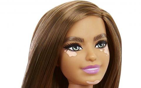 vitiligo Barbie