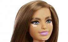vitiligo Barbie