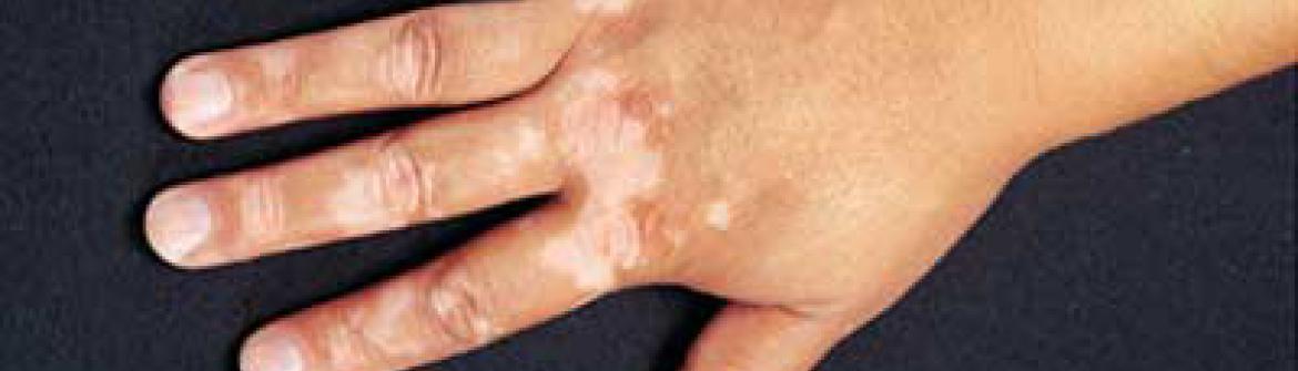 diagnosticul vitiligo
