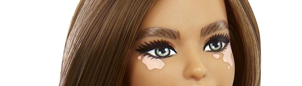 vitiligo Barbie